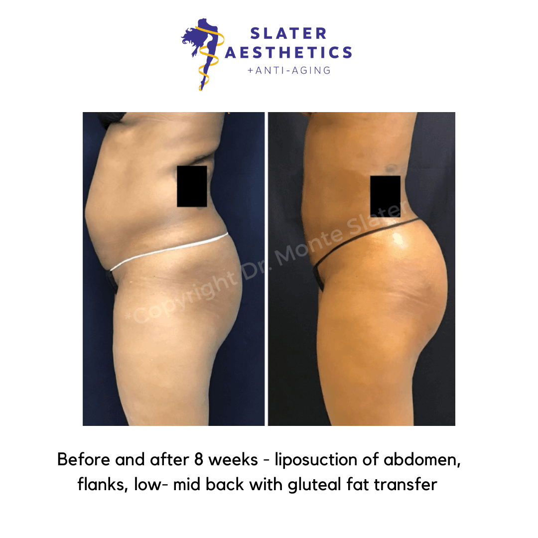 Before and after 8 weeks of liposuction of abdomen, flanks, low-mid-back with fat transfer to the buttocks - BBL - Brazilian Butt Lift by Dr. Monte Slater
