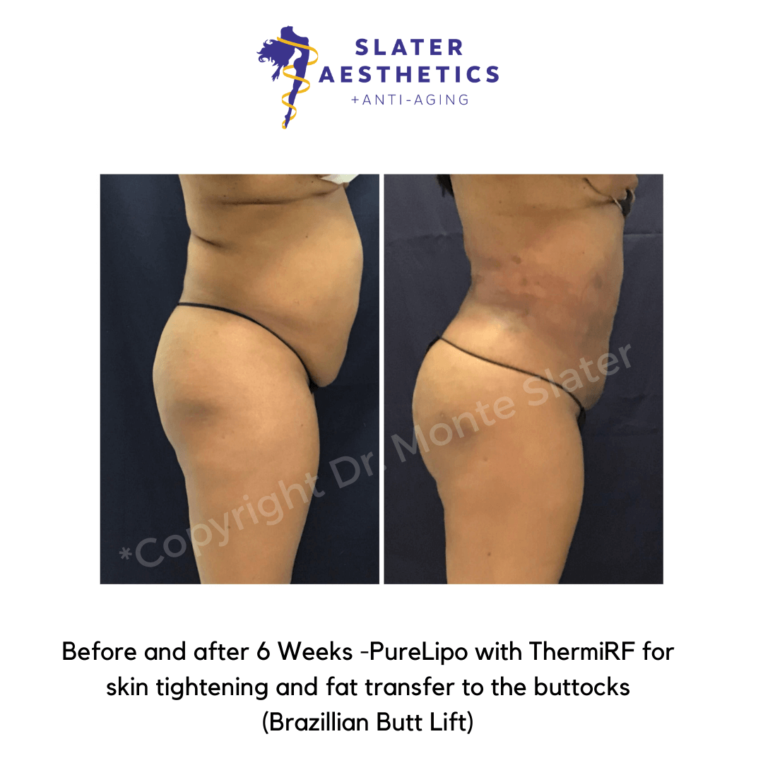 Before and after 6 weeks of Liposuction of abs, flanks, low-back, mid-back with ThermiTight for skin tightening and fat transfer to buttocks -BBL - Brazilian Butt Lift by Dr. Monte Slater