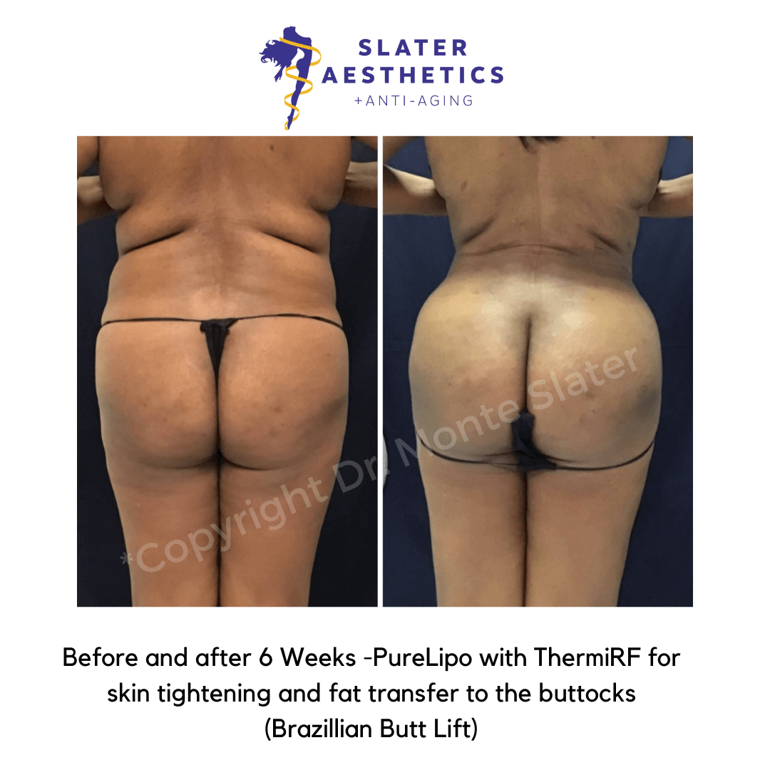 Before and after 6 weeks of Liposuction of abs, flanks, low-back, mid-back with ThermiTight for skin tightening and fat transfer to buttocks -BBL - Brazilian Butt Lift by Dr. Monte Slater