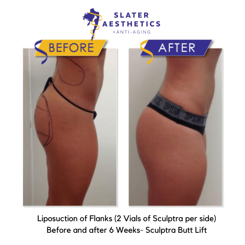 Before and after 6 weeks of Liposuction of the Flanks and 2 vials of sculptra per side - Sculptra Butt Lift by Dr. Monte Slater