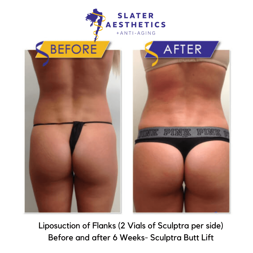 Before and after Liposuction of the Flanks and 2 vials of sculptra per side before and after 6 weeks