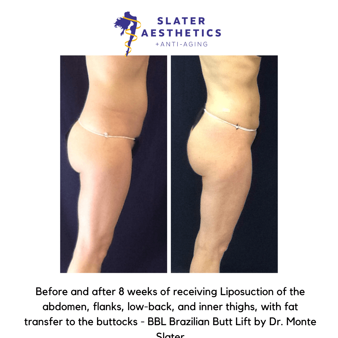 Before and after 8 weeks of receiving Liposuction of the abdomen, flanks, low-back, and inner thighs, with fat transfer to the buttocks - BBL Brazilian Butt Lift by Dr. Monte Slater