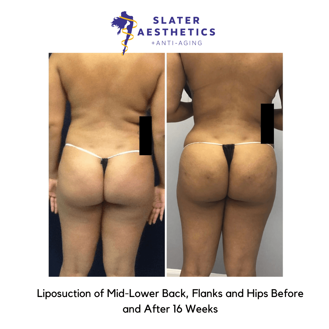 Before and after lipo with fat transfer
