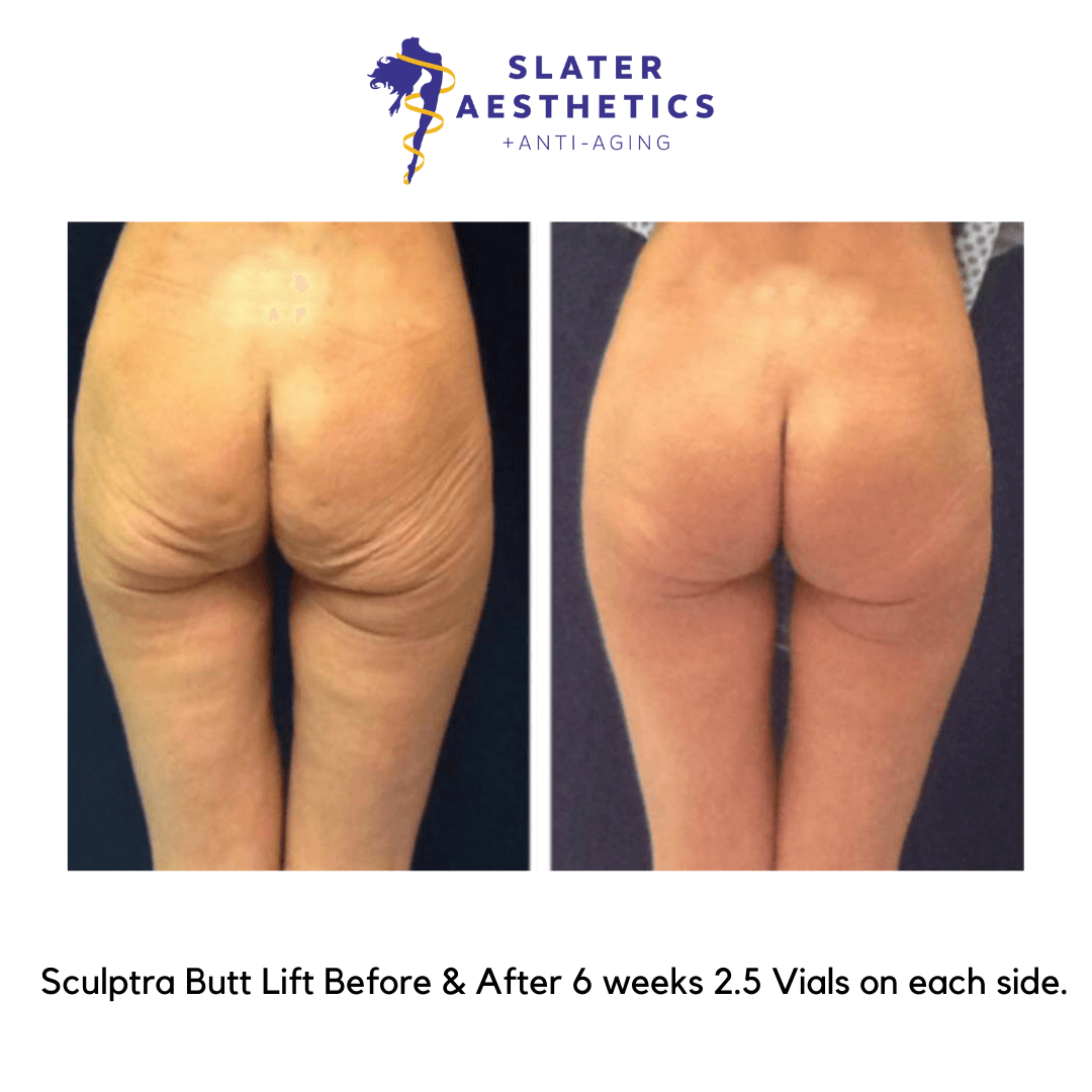 Before and after 6 weeks of receiving 2.5 vials of sculptra per side - Sculptra Butt Lift By Dr. Monte Slater