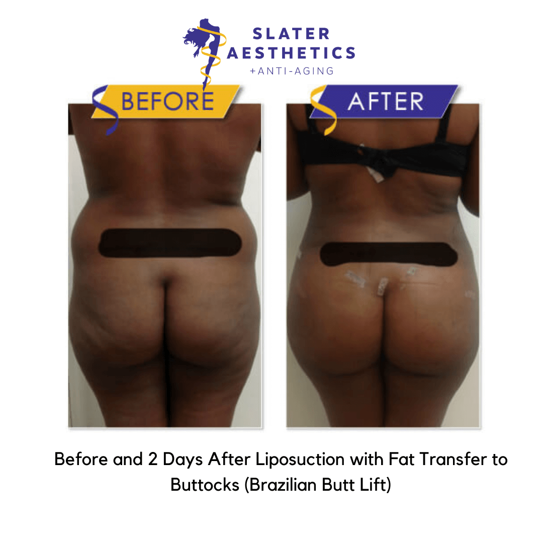 Before and after 2 days Liposuction and fat transfer to the buttocks - BBL Brazilian Butt Lift by Dr. Monte Slater