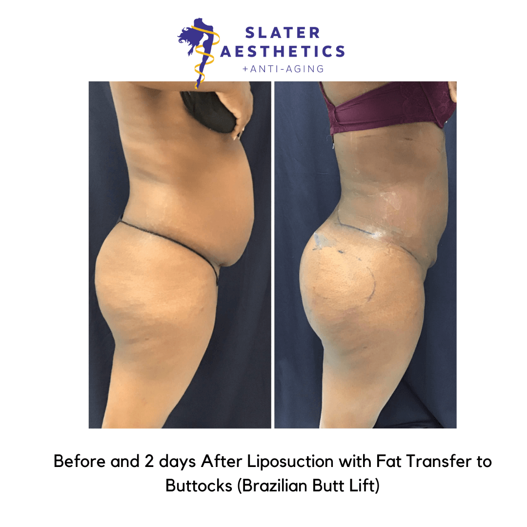 Before and after 2 days of receiving Liposuction of the abdomen, low-back with fat transfer to the buttocks - BBL Brazilian Butt Lift by Dr. Monte Slater
