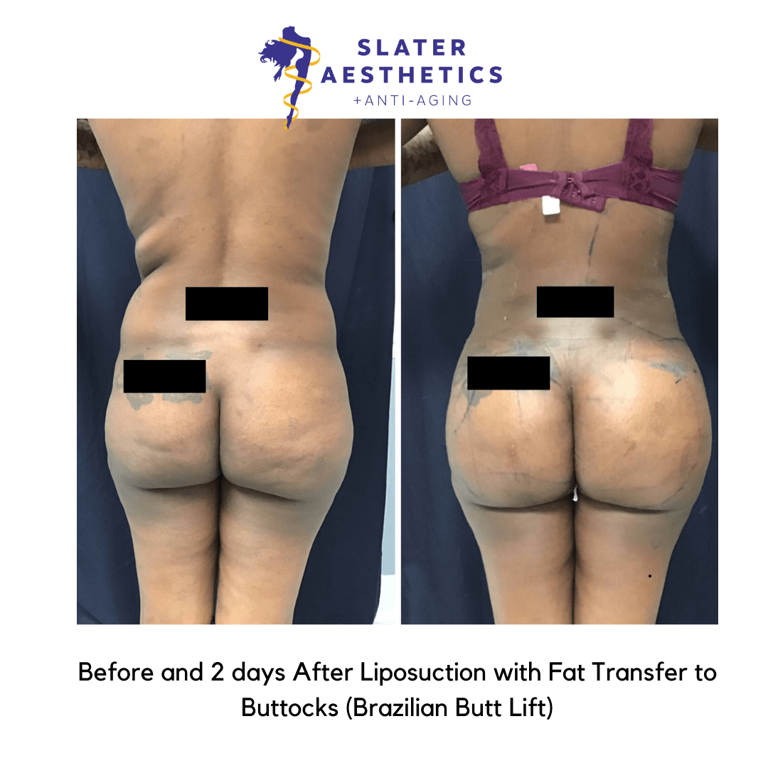 Before and after 2 days of receiving liposuction of the abs, low-back with fat transfer to the buttocks - BBL - Brazilian Butt lift by Dr. Monte Slater