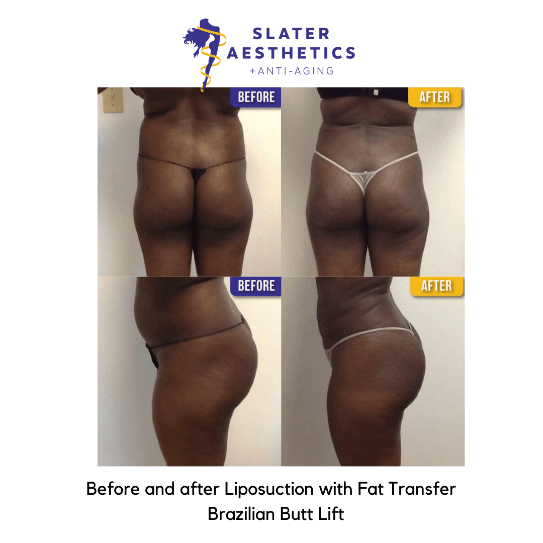 Before and after liposuction with fat transfer to the buttocks - BBL by Dr. Monte Slater