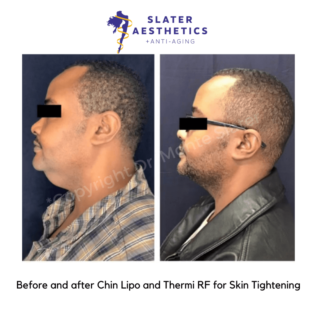 Before and after lipo for chin with thermi for skin tightening