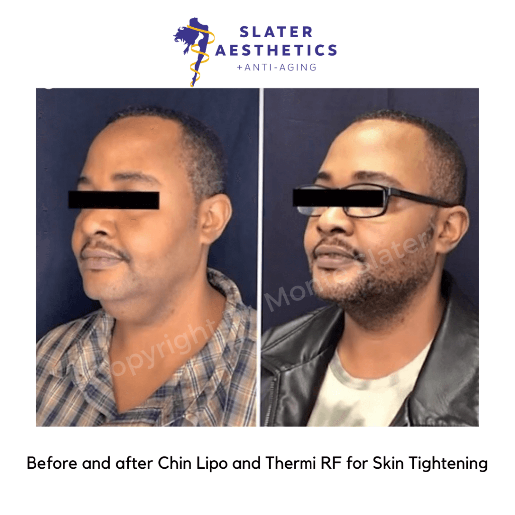 Before and after Liposuction of chin with ThermiTight for skin tightening by Dr. Monte Slater