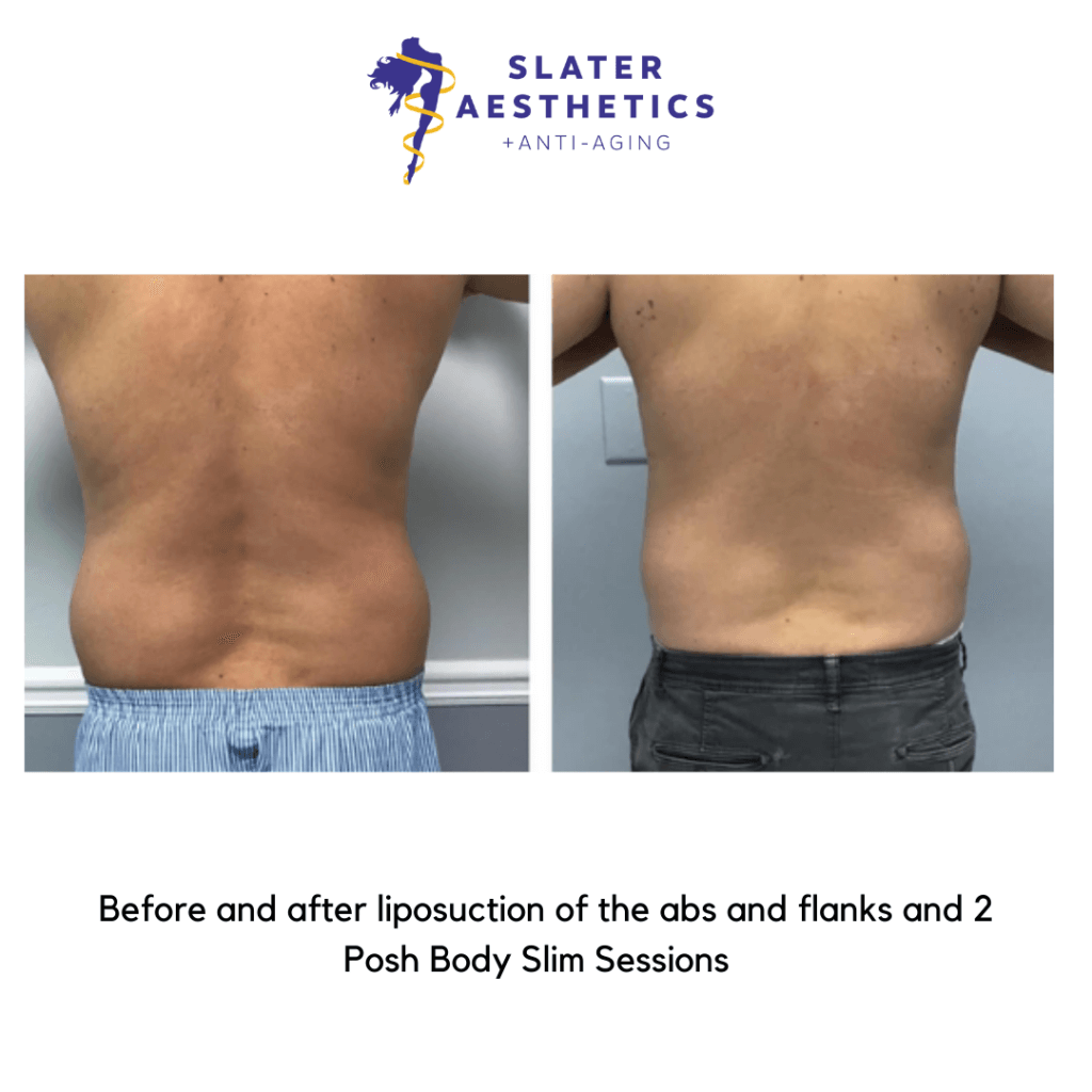 Before and after Liposuction of the abs, flanks, and low -back by Dr. Monte Slater