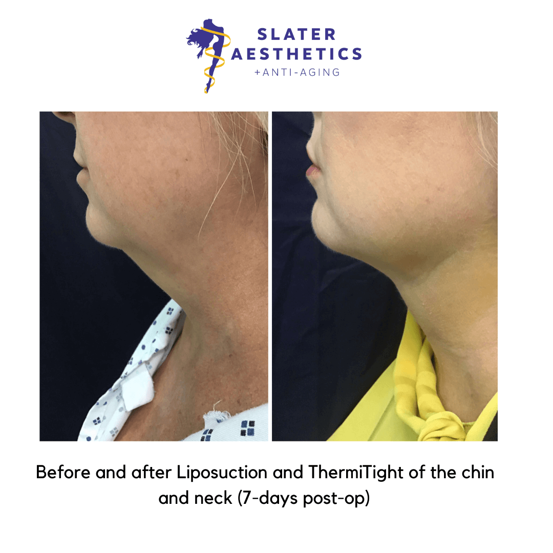 before and after chin liposuction with ThermiTight by Dr. Slater