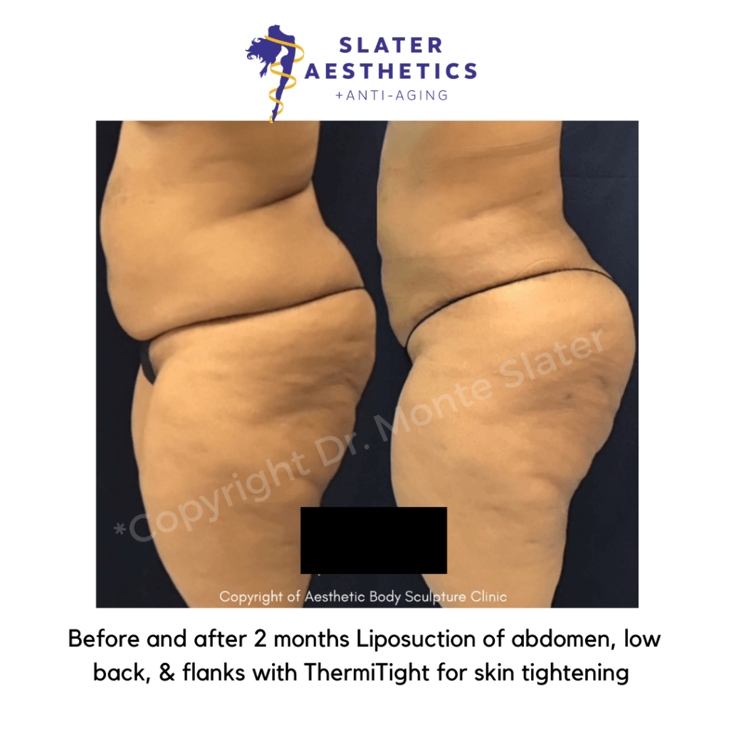 Before and after lipo and thermitght by Dr. Slater side view