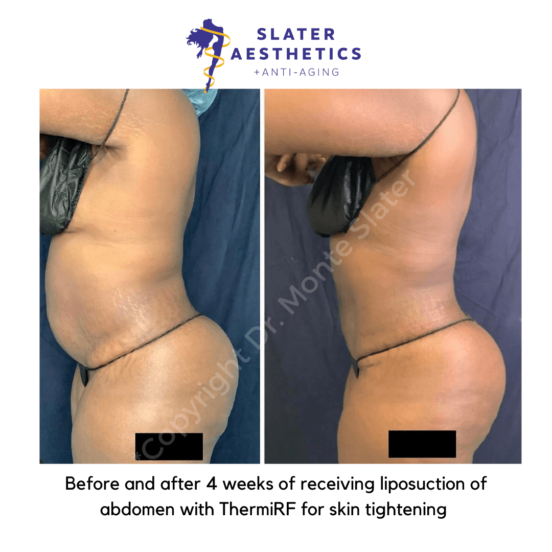 Before and after Liposuction by Dr. Monte Slater with Thermitight