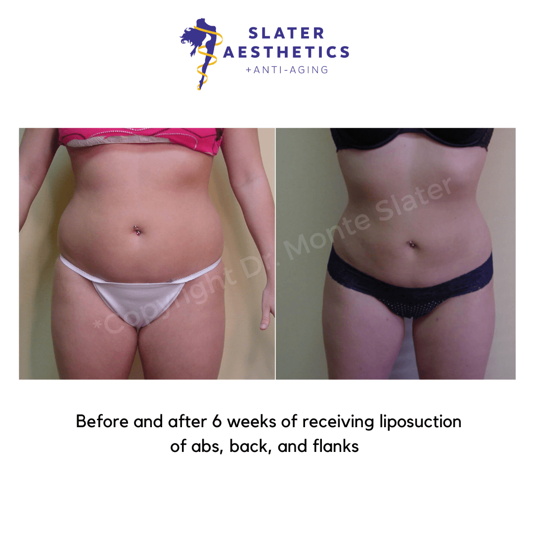 Before and after liposuction front view Slater Aesthetics