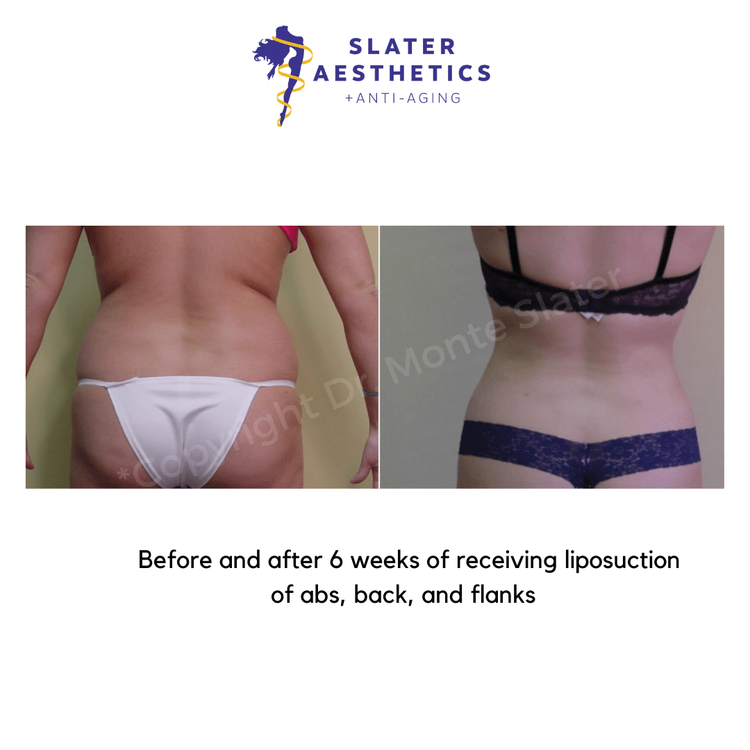 before and after Purelipo - Liposuction back view