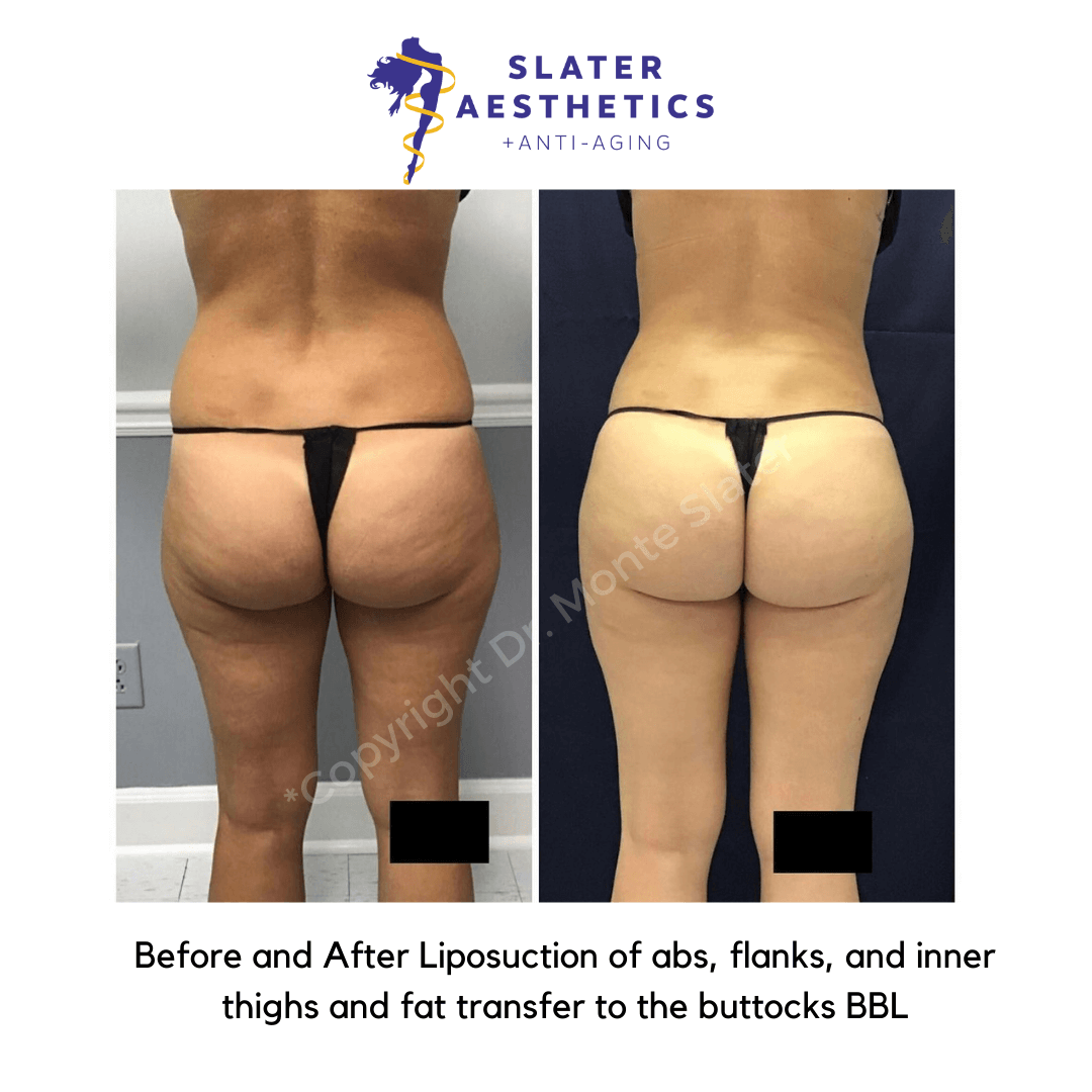 Before and after liposuction of abs, flanks, and inter thighs and fat transfer to the buttocks - BBL Brazilian Butt Lift by Dr. Monte Slater