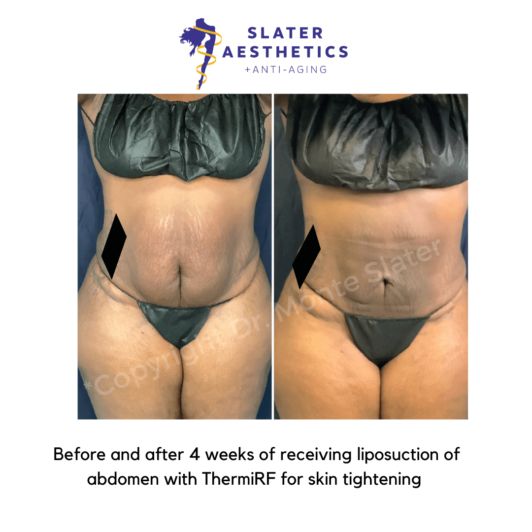 Liposuction of abs and thermitight