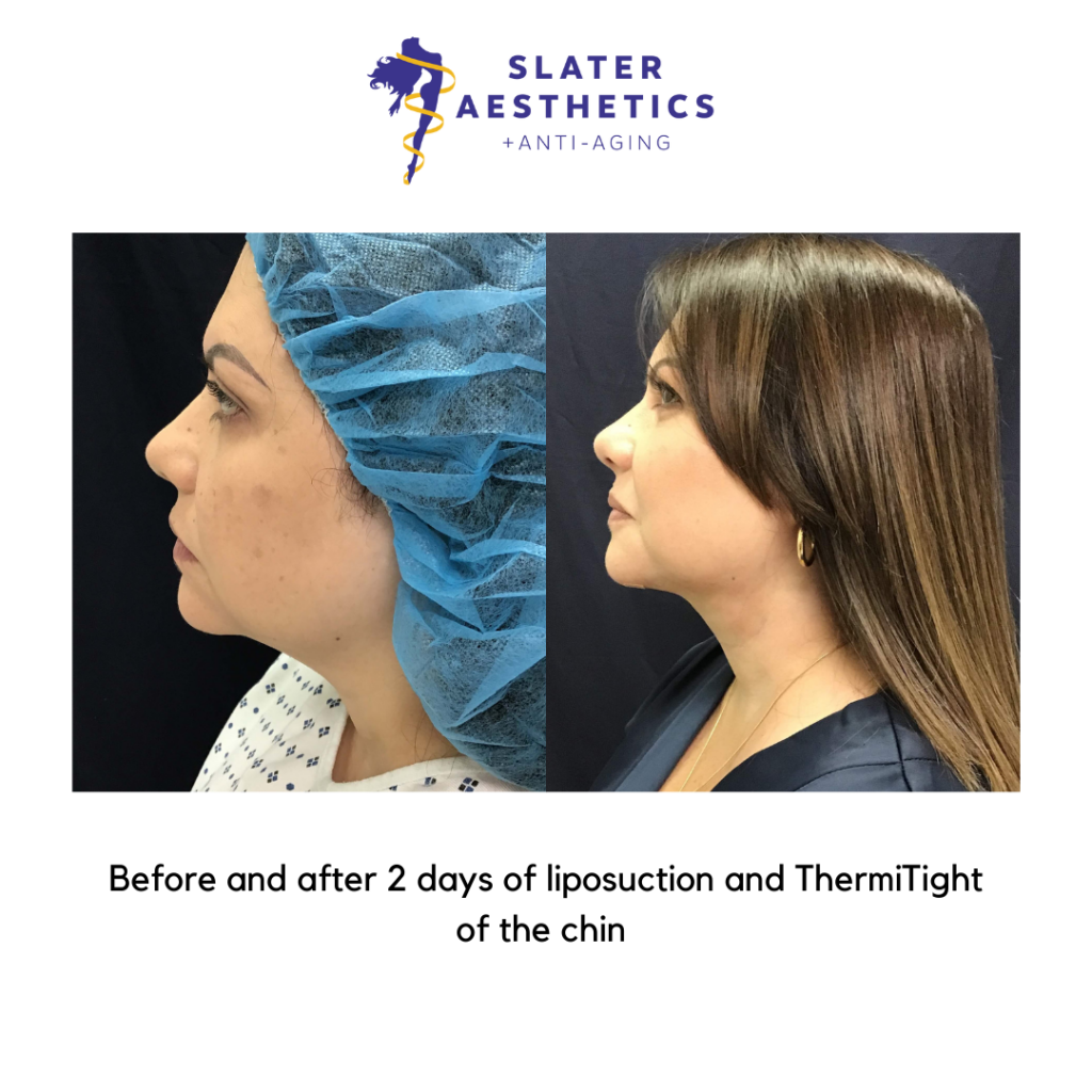 Before and after liposuction of the chin by Dr. Monte Slater