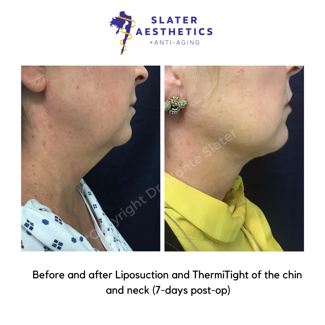 Left view before and after chin liposuction - slatermd