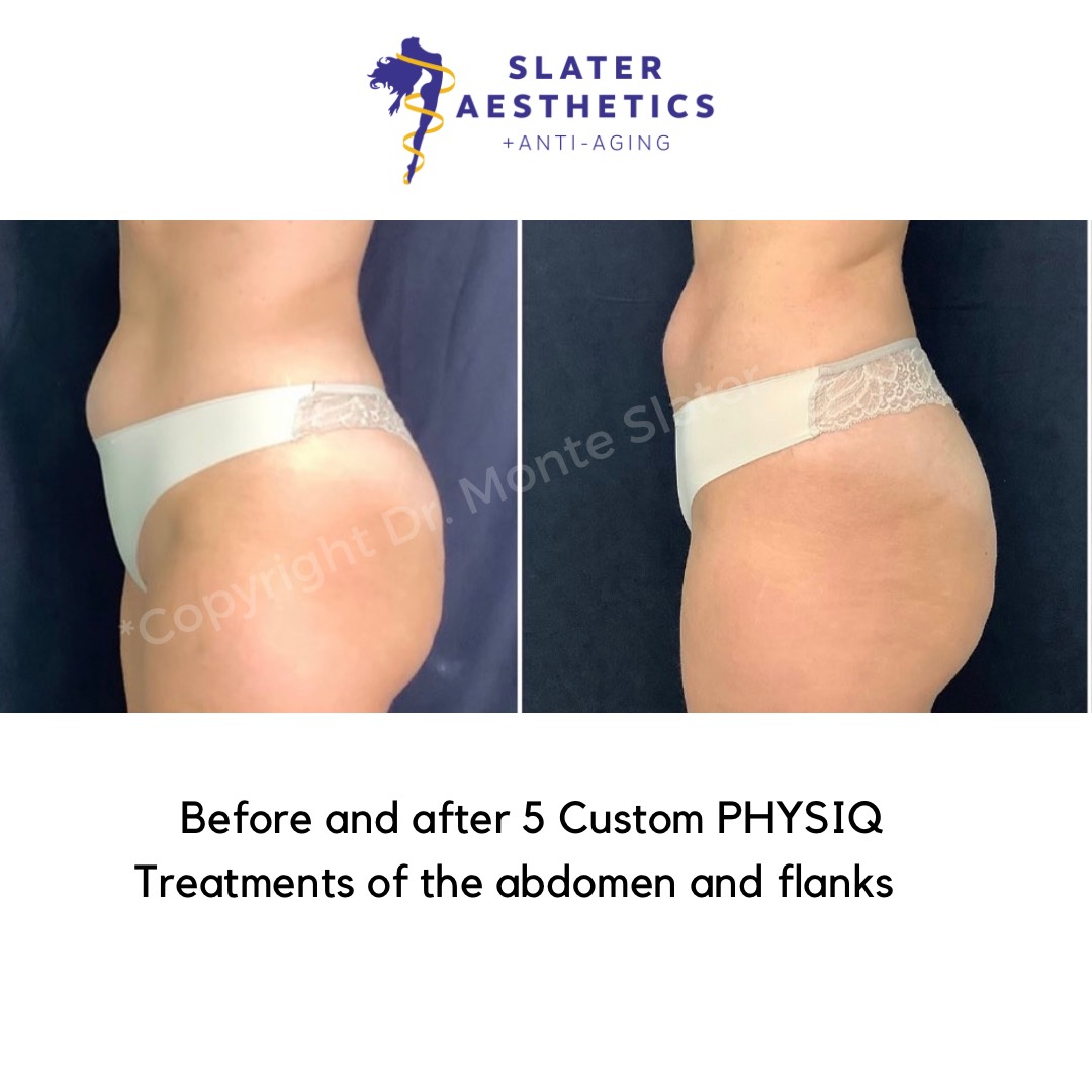 Abs and Flanks Before and after 5 custom treatments with PHYSIQ