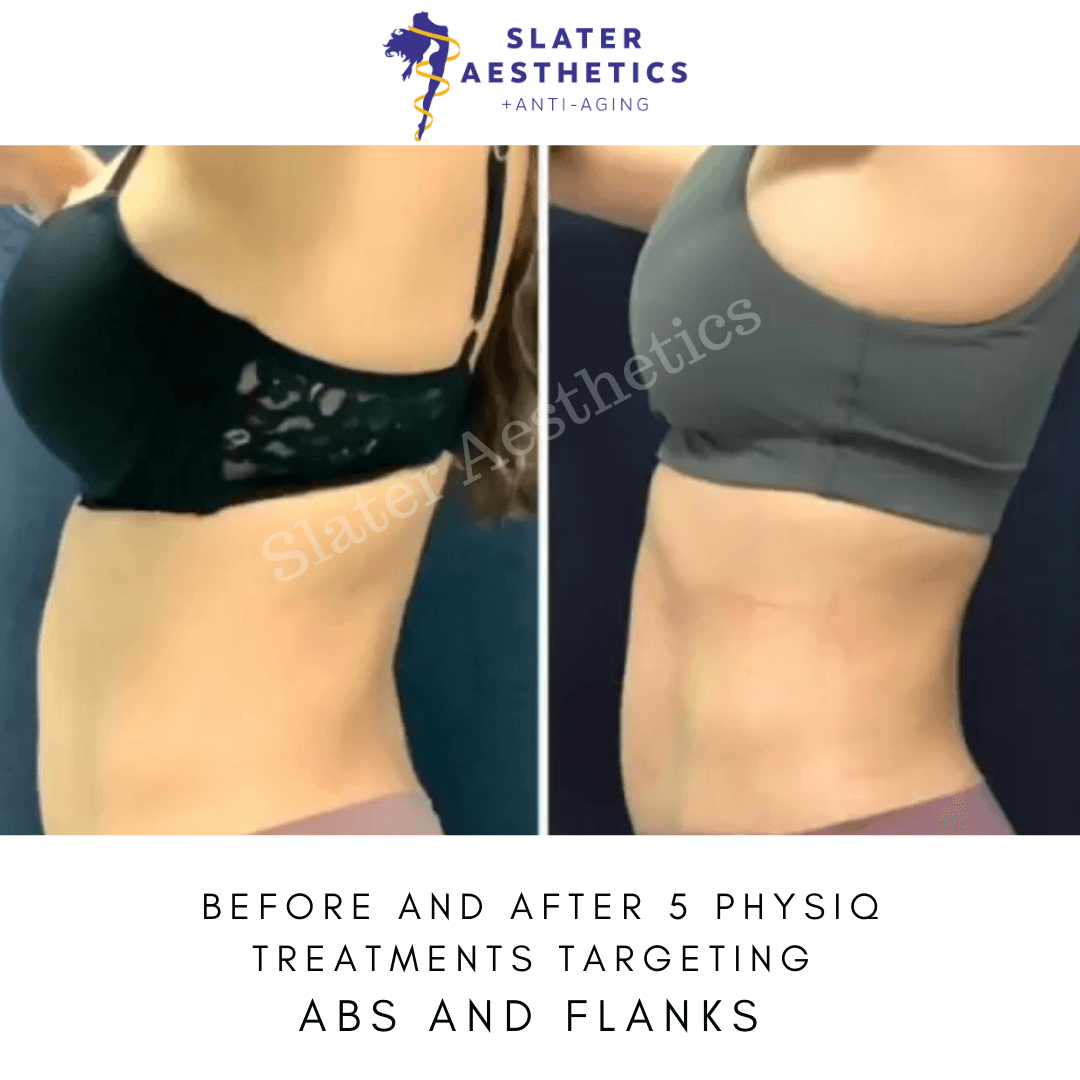 Before and after 5 PHYSIQ Body Contouring treatments at Slater Aesthetics