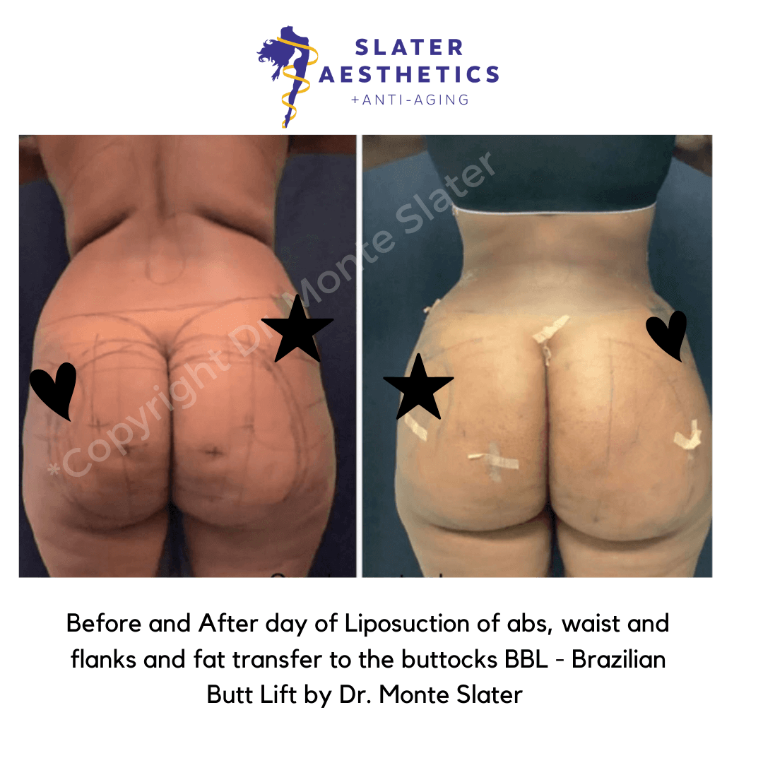 Before and after 1 day of liposuction with fat transfer to the buttocks - BBL by Dr. Monte Slater