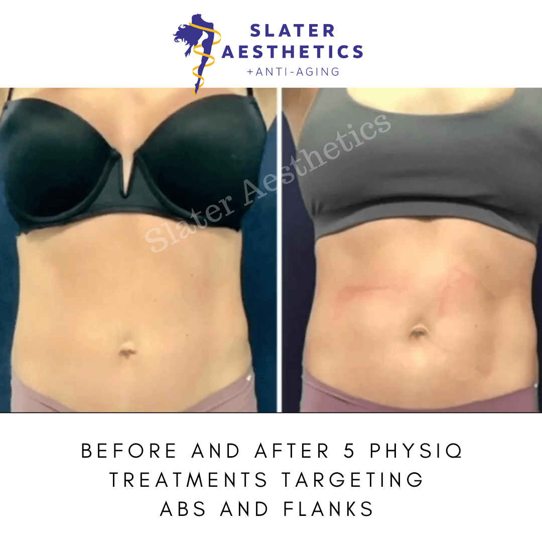 Physiq before and after 5 treatments at Slater aesthetics