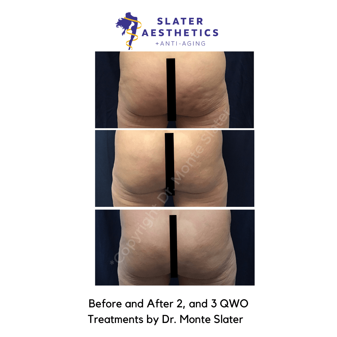 Before and after 2 and 3 QWO Cellulite injections