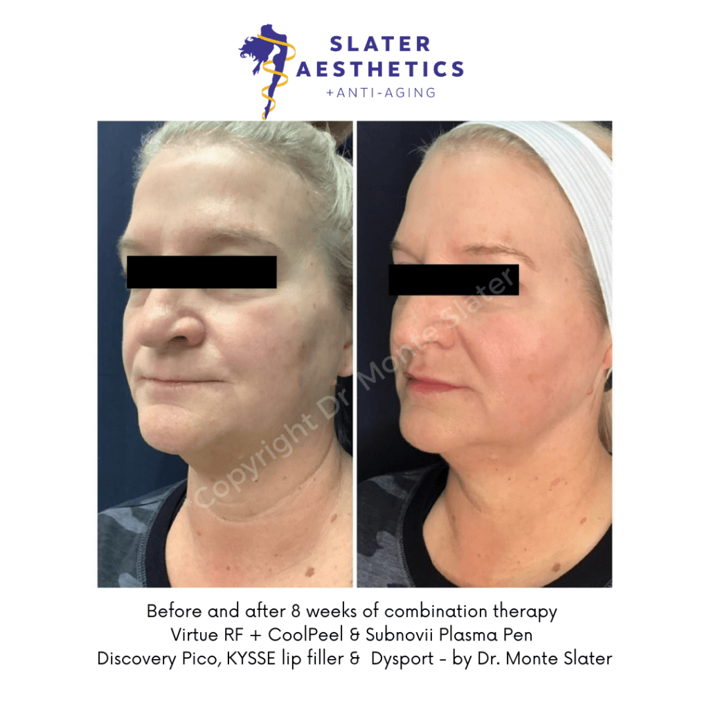 Before and after Combination Therapy with Virtue RF, CoolPeel, Subnovii 8 week result