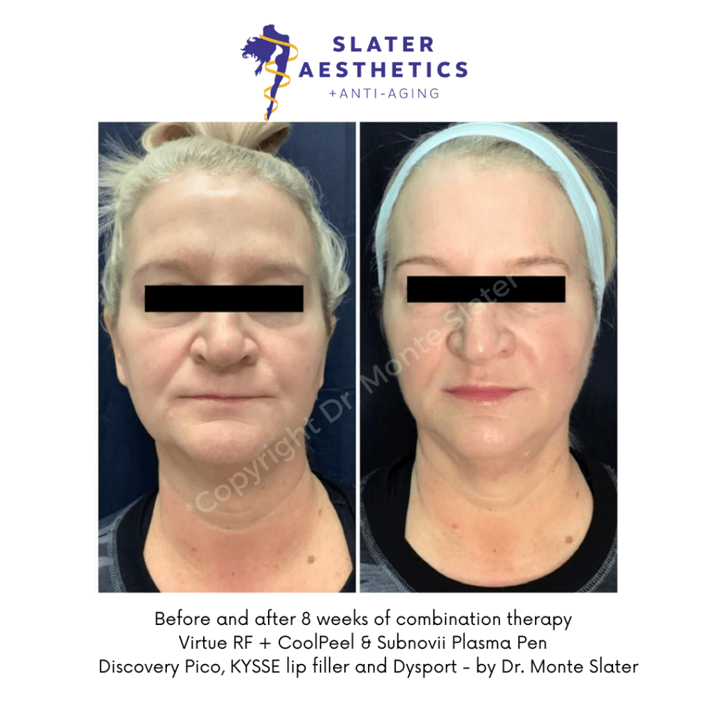 Before and after Combination Therapy with Virtue RF, CoolPeel, Subnovii 8 week result