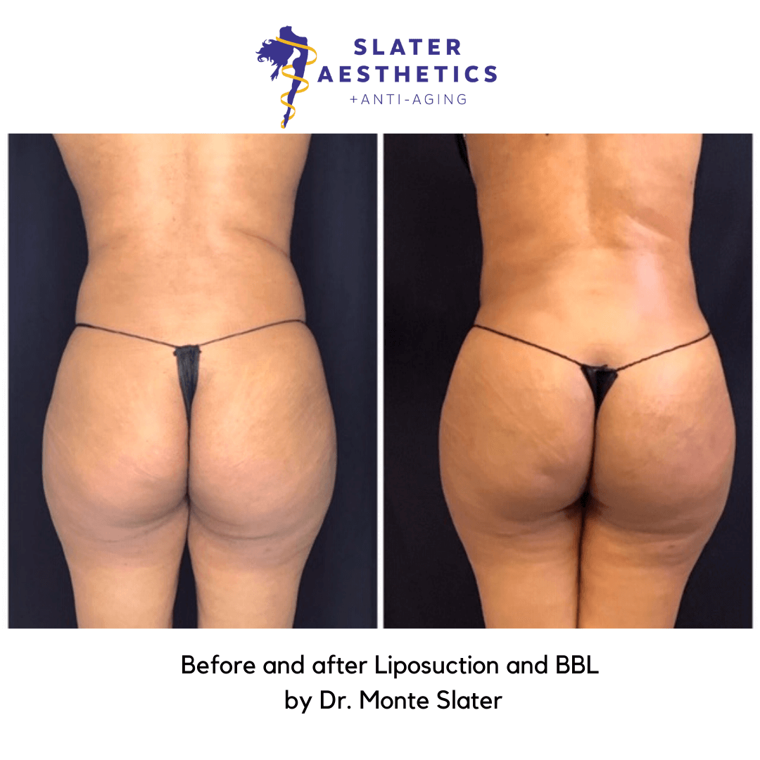 Brazilian Butt Lift - Before and after Lipsuction and Brazilian Butt Lift at Slater Aesthetic and Anti-Aging