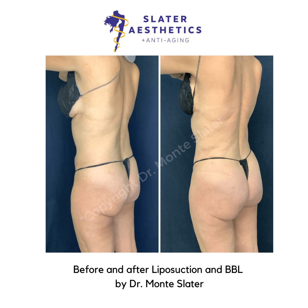 Before and after Lipsuction and Brazilian Butt Lift at Slater Aesthetic and Anti-Aging