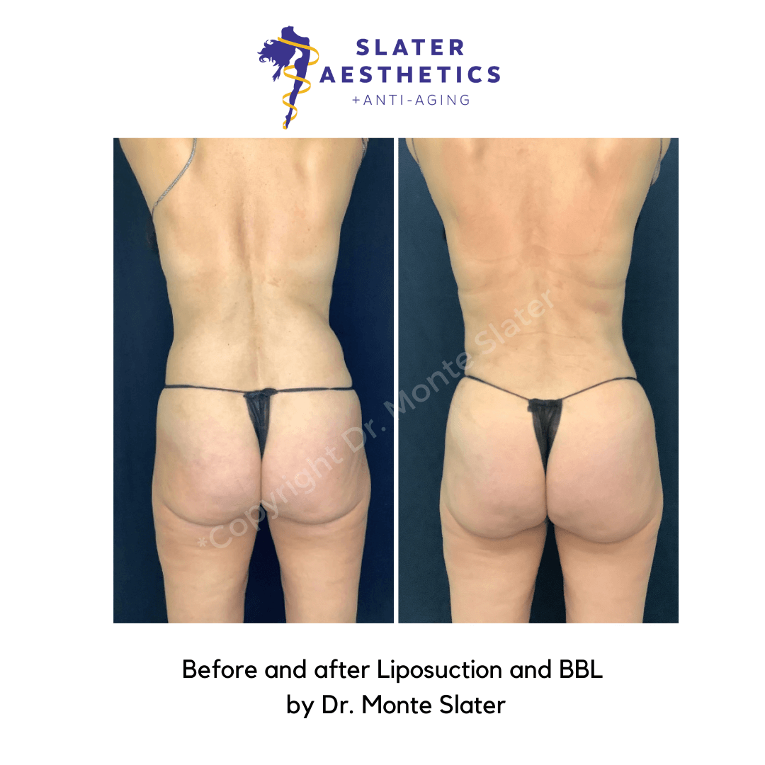 Before and after receiving Liposuction of the abdomen, low-back with fat transfer to the buttocks - BBL Brazilian Butt Lift by Dr. Monte Slater