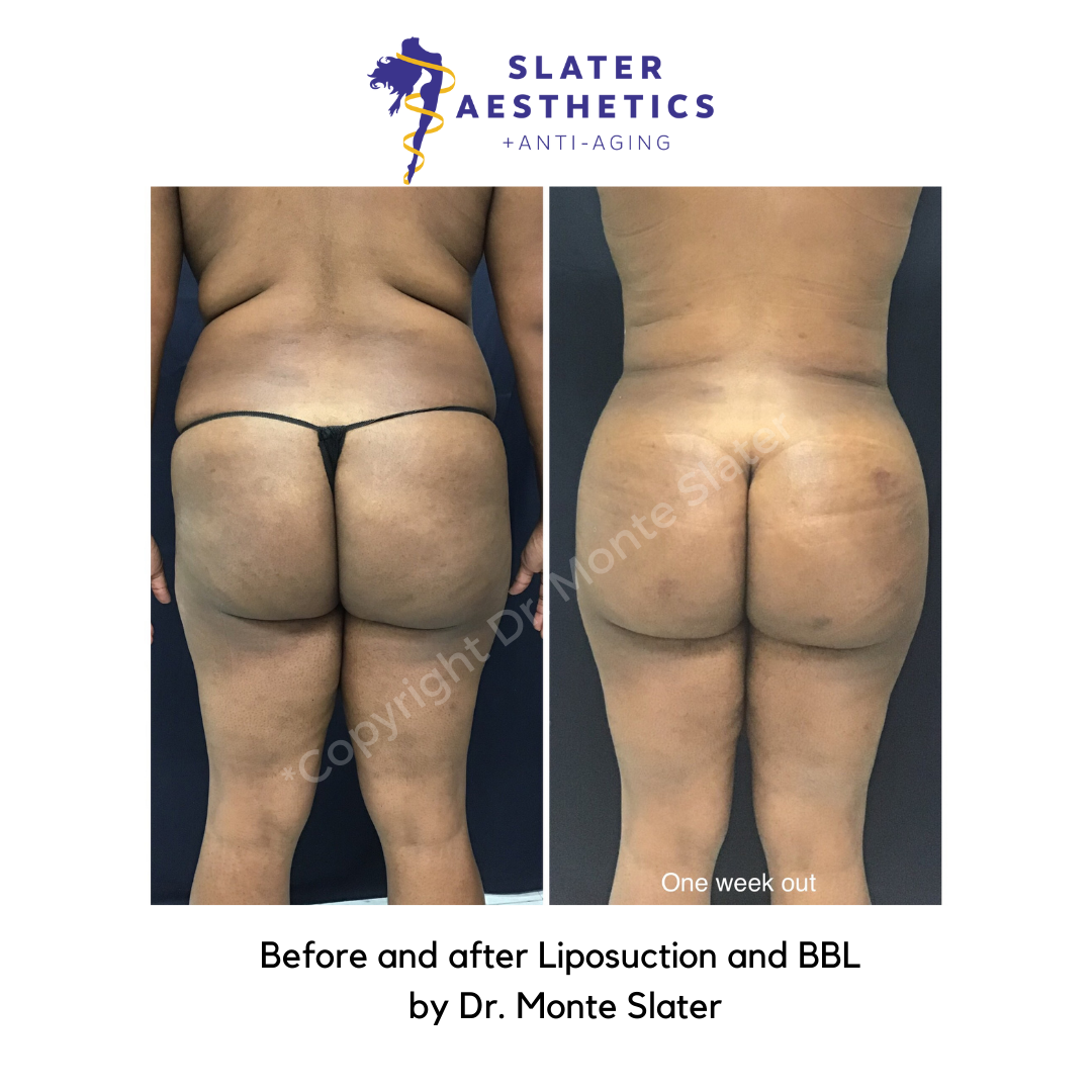 Brazilian Butt Lift Before and After Liposuction and Fat Transfer