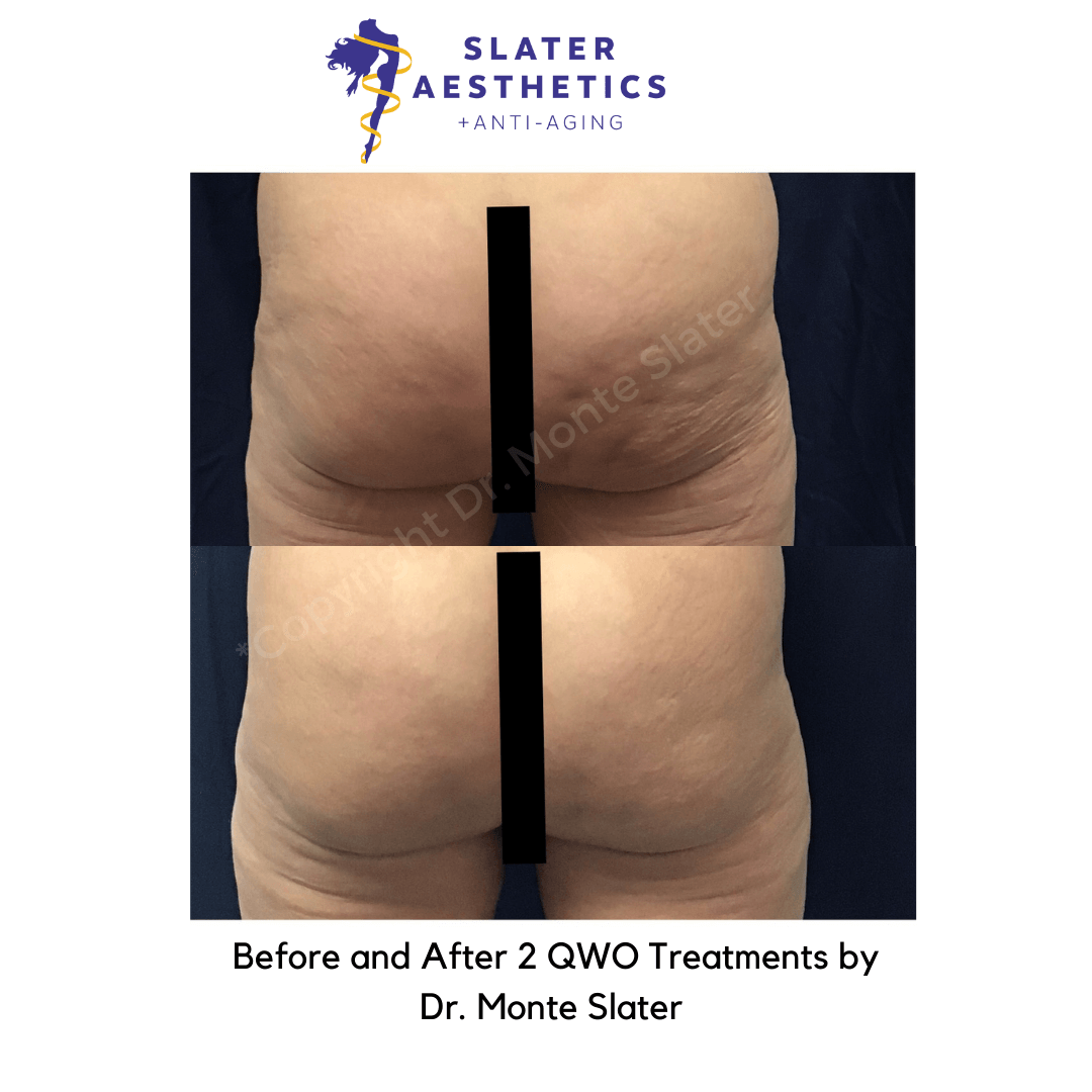 Before and after 2 QWO cellulite treatments by Dr. Monte Slater