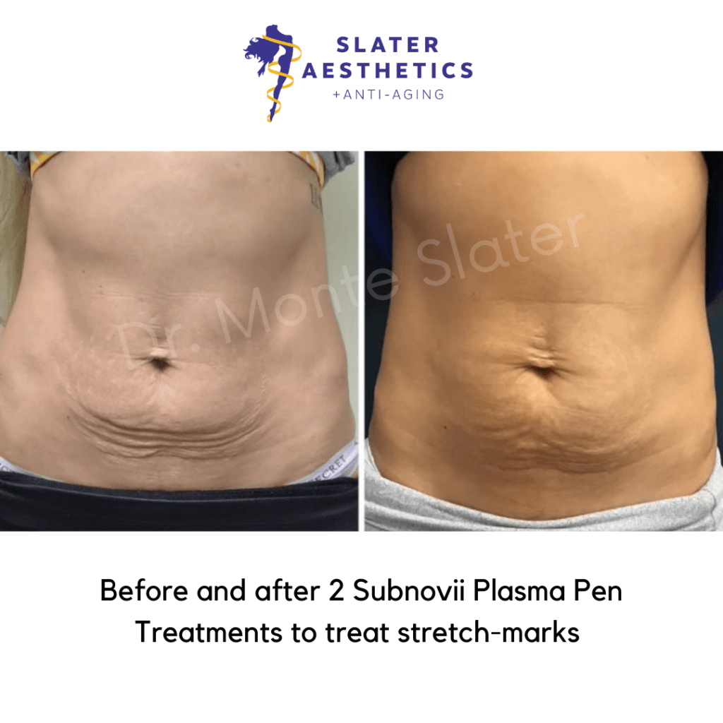 before and after just two treatments by Dr. Slater with the Plasma Pen