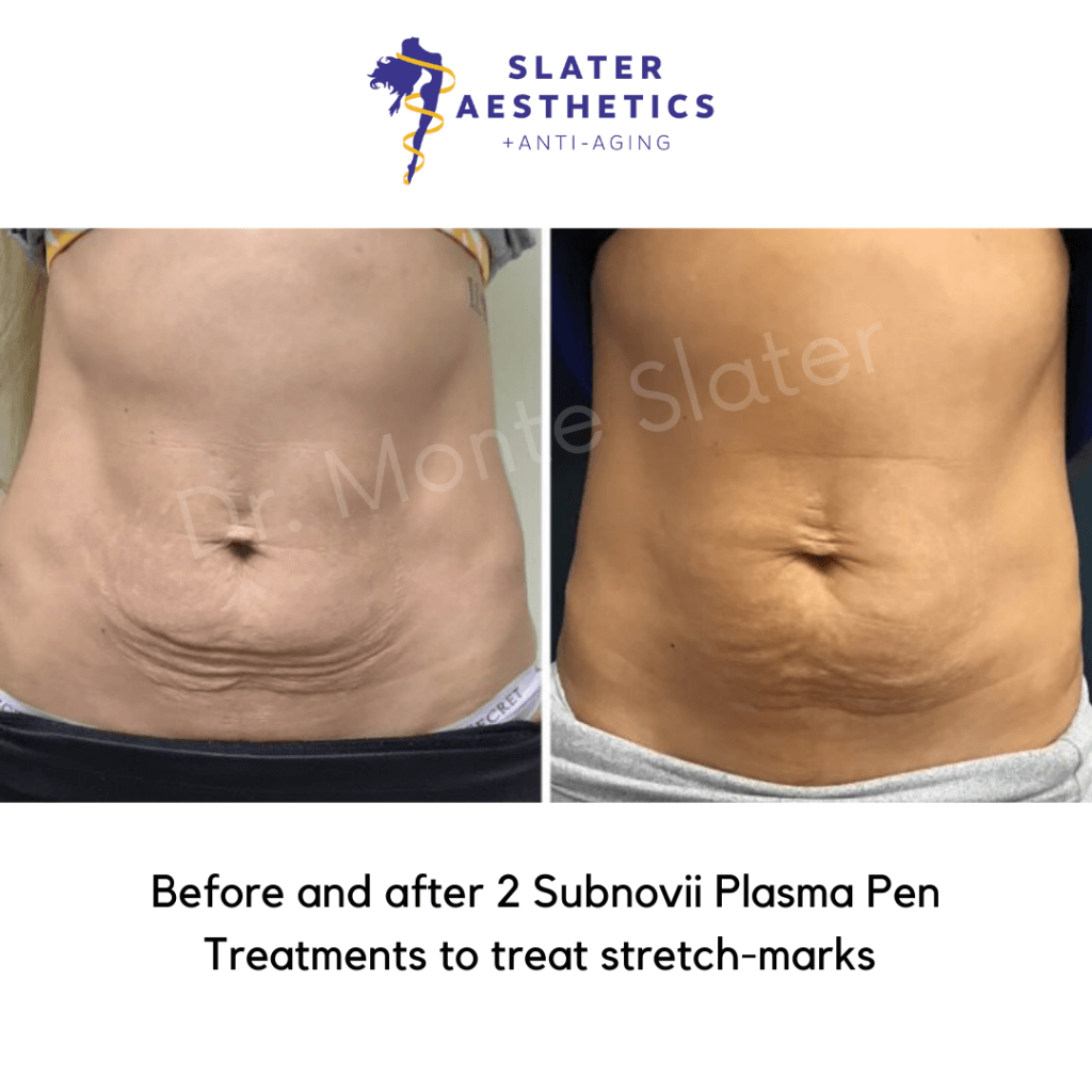 Brazilian Butt Lift & Sculptra Butt Lift Results - Dr. Monte Slater