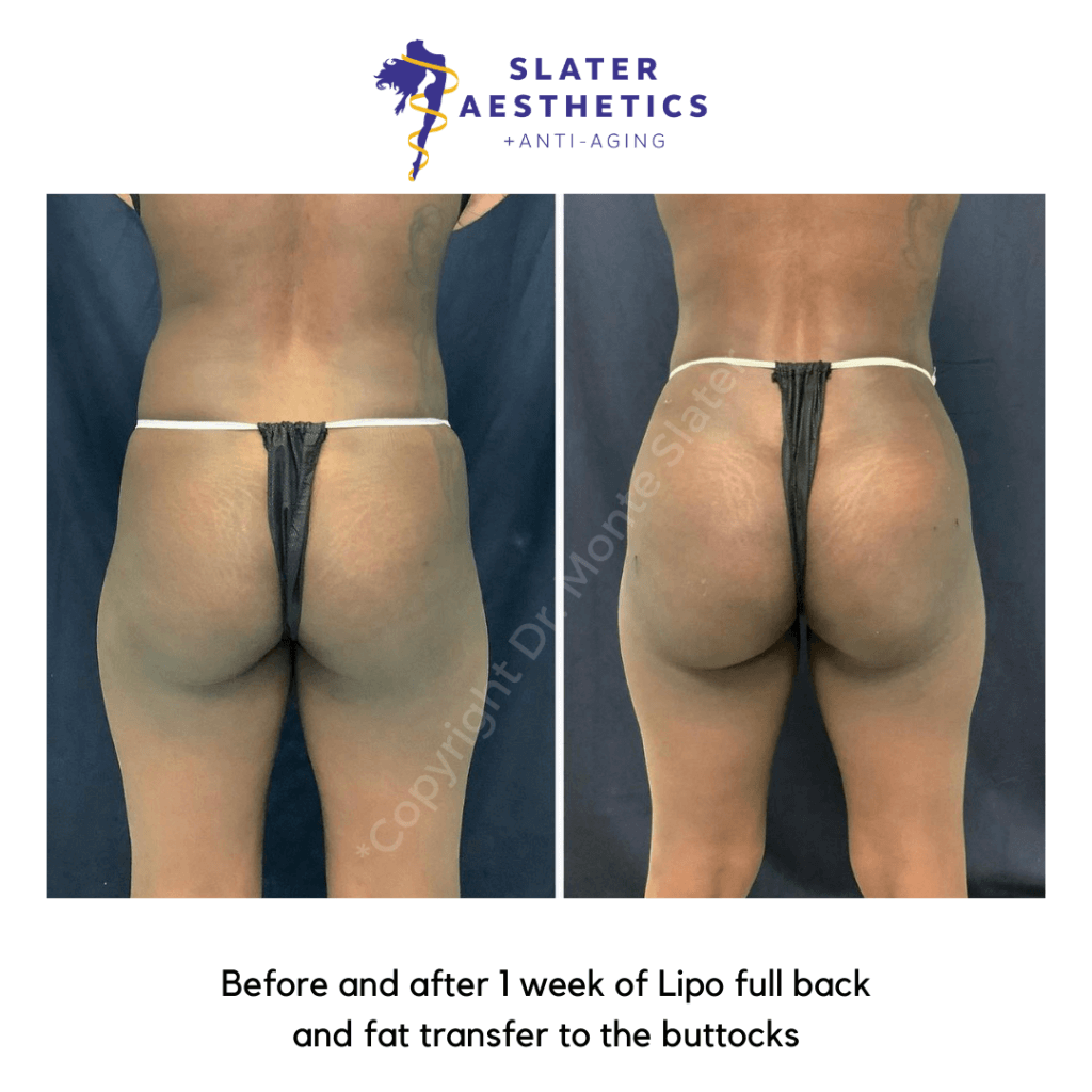 Before and After Lipo & Fat Transfer to the Buttocks
