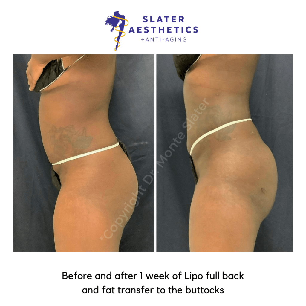 Before and After Lipo & Fat Transfer to the Buttocks