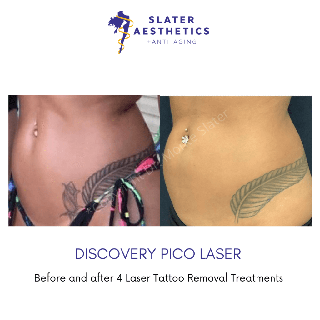 Before and After Discover Pico Laser - Slater Aesthetics and Anti-Aging