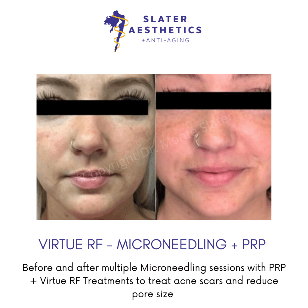 before-and-after-virtue-rf-microneedling-prp-slater-aesthetics-and-anti-aging-