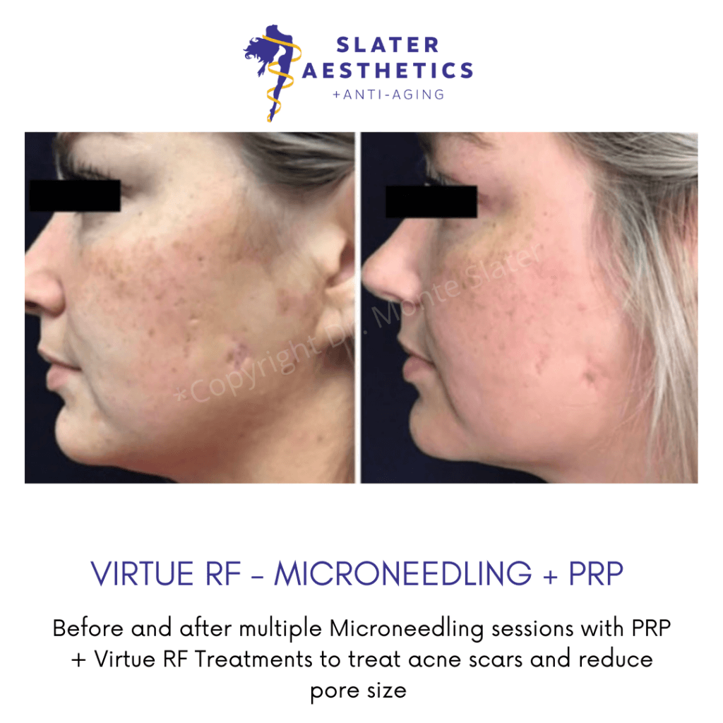 Before and After Virture RF, PRP, & Microneedling