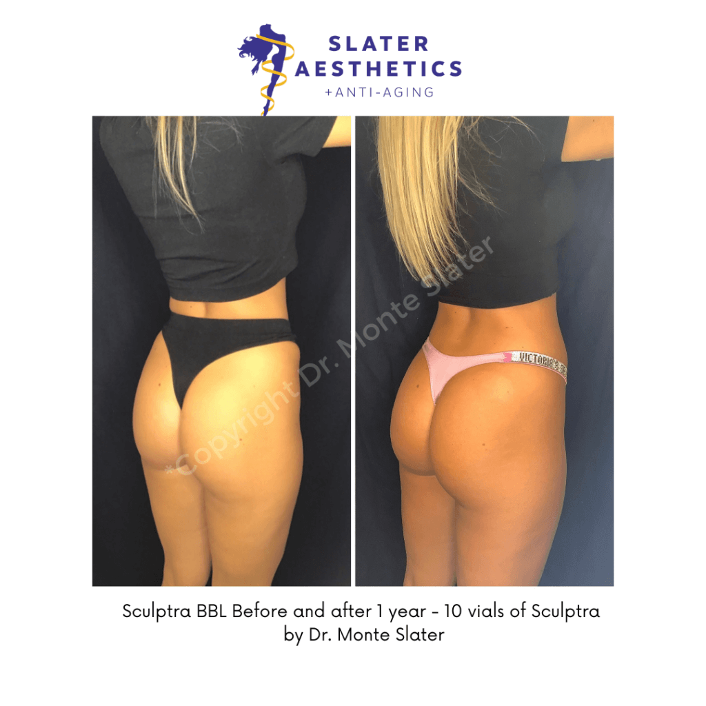 Before and after Sculptra Butt Lift by Dr. Monte Slater