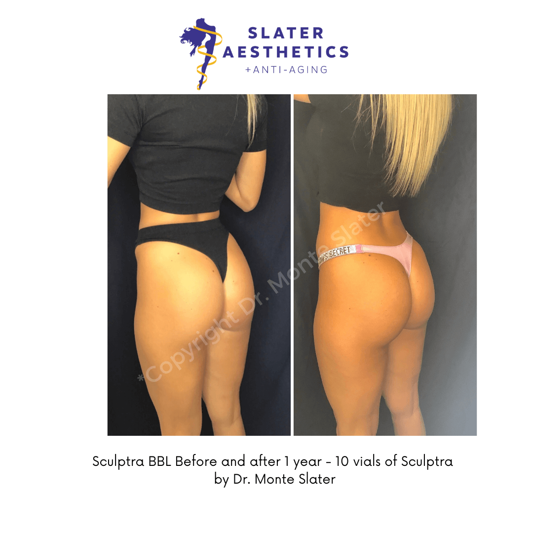 Before and after Sculptra Butt Lift by Dr. Monte Slater