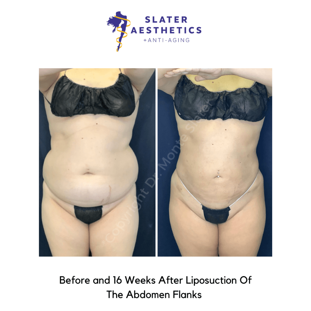 before-and-16-weeks-after-liposuction-of-the-abdomen-flanks-at-slater-aesthetic-anti-aging-clinic