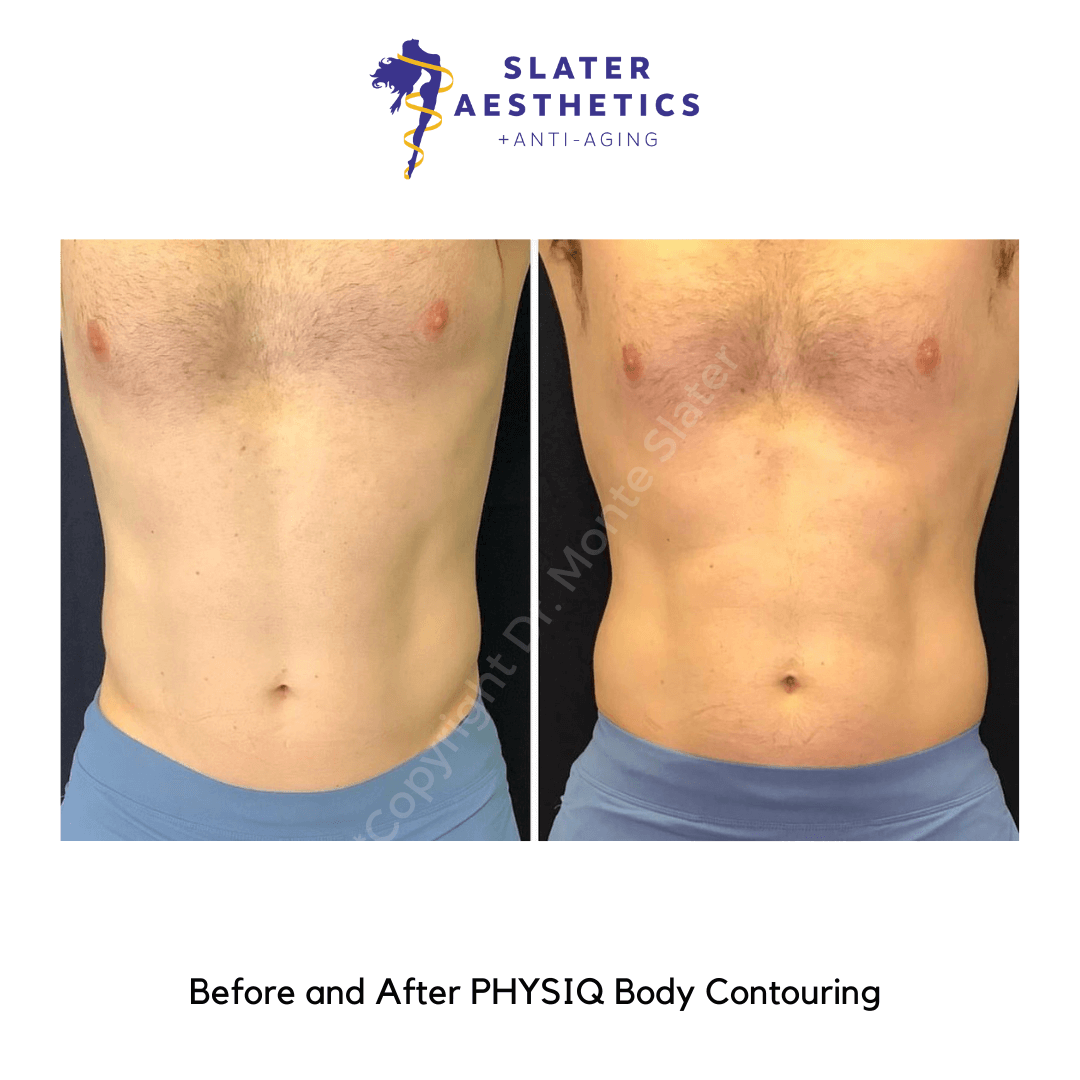 PHYSIQ before-and-after-slater-aesthetic-anti-aging-clinic