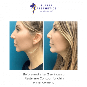 Before and aftter injectables for chin enhancement