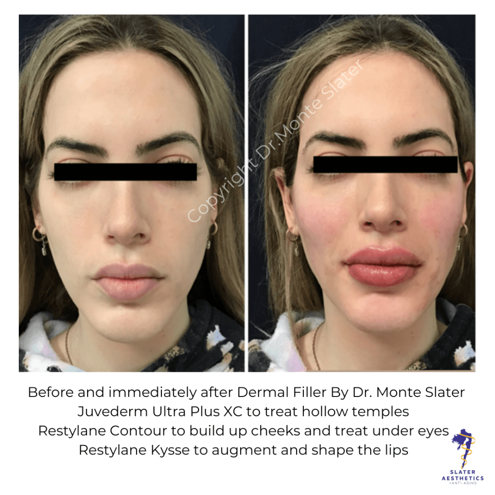 Juvederm fillers at slater aesthetics atlanta and warner robins