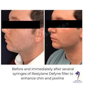 before-and-immediately-after-restylane-defyne-for-chin-enhancement-4